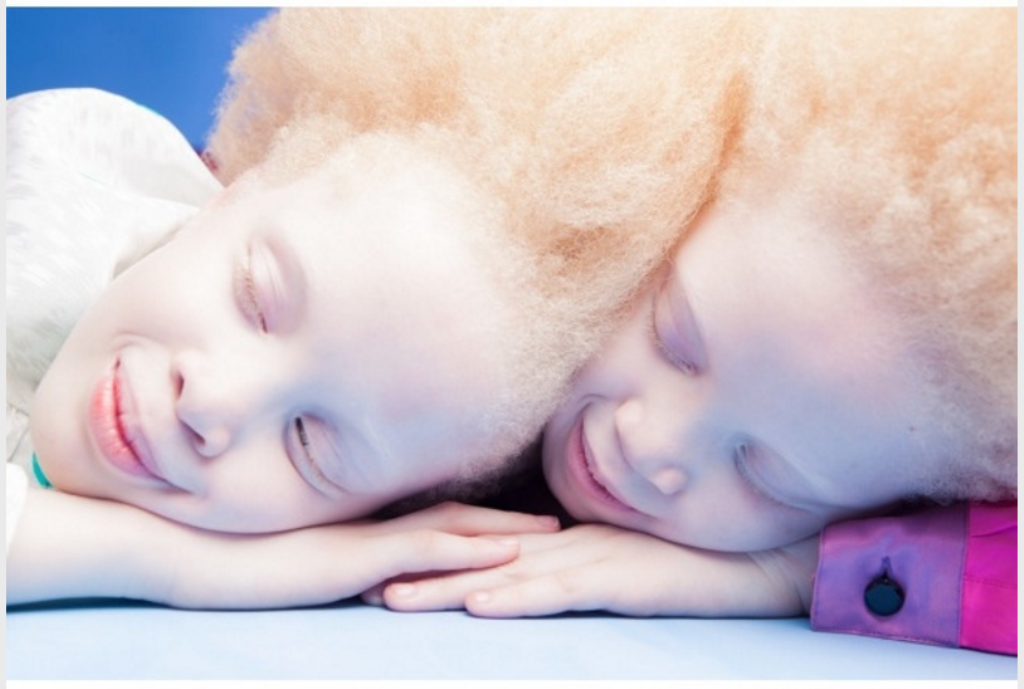 albino_bliznakinje_indexhr2.PNG - Predivne albino bliznakinje svojom jedinstvenošću osvojile svijet