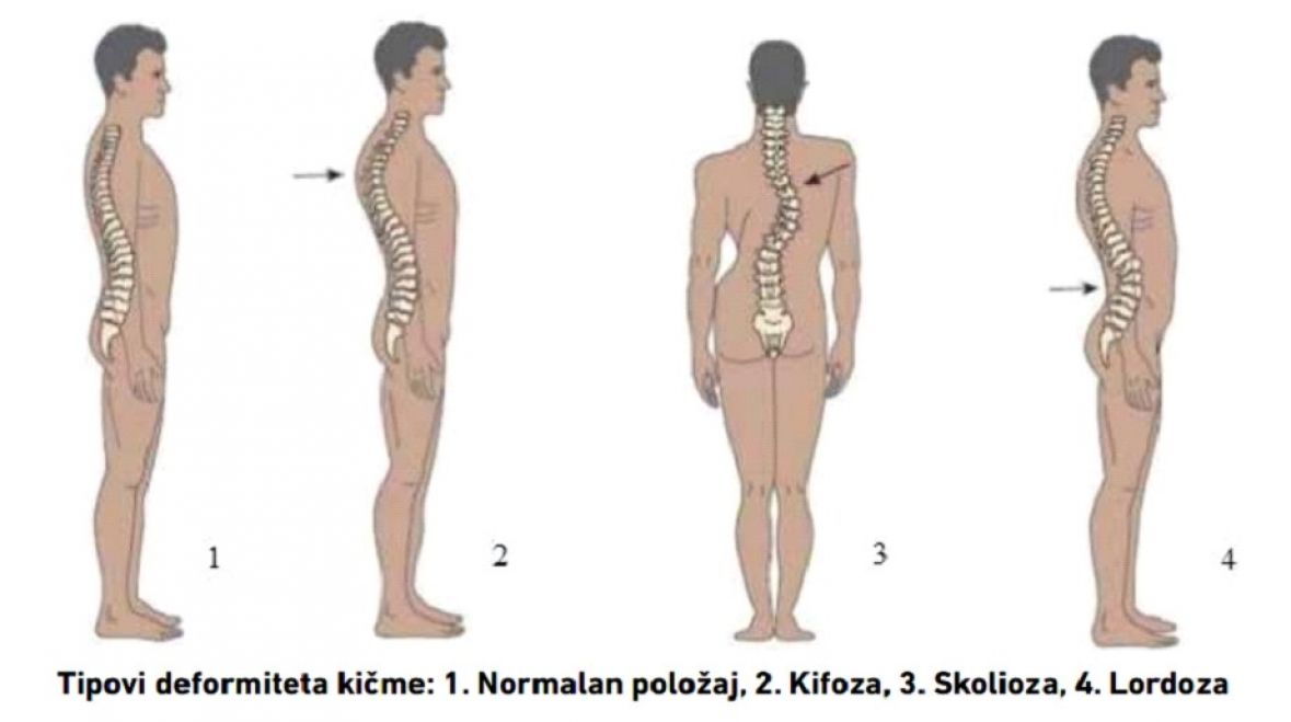 Rano otkrivanje poremećaja lokomotornog sistema učenika osnovnih i srednjih škola u ZDK - undefined