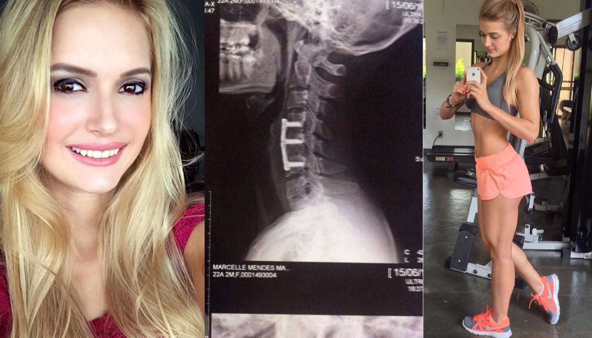 Marcelle Mancuso, fitness model na Instagramu, ostala paralizirana - undefined