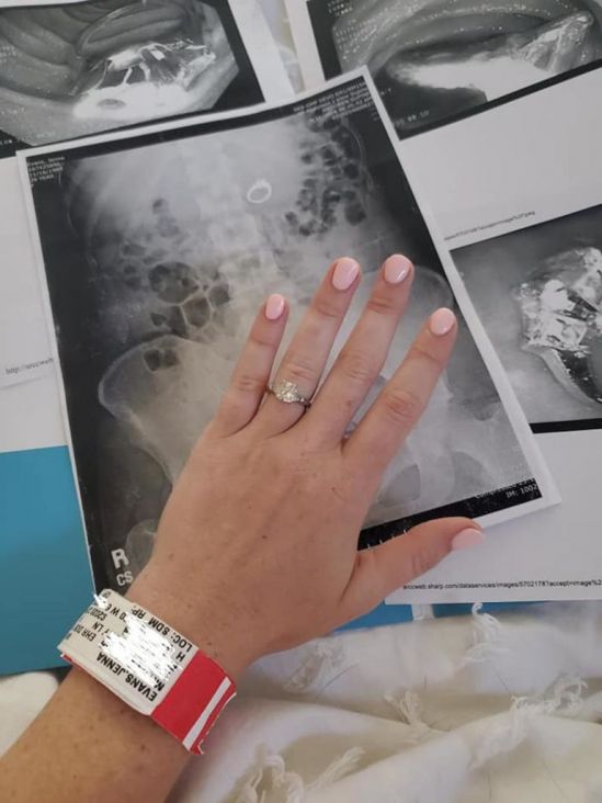 Jenna Evans (29) iz Kalifornijeprogutala zaručnički prsten - undefined