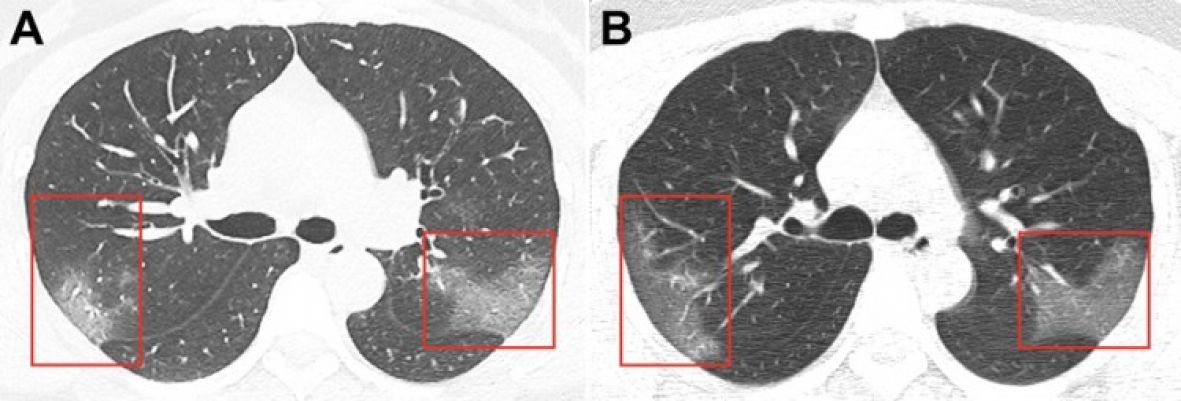 CT snimak pluća - undefined