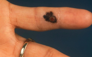 Ako opazite ovo na vašem prstu, odmah idite doktoru 