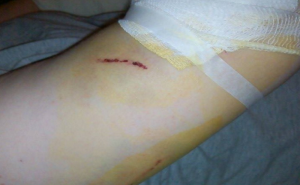 Sedamnaestogodišnju Džejlanu napao čopor pasa: Čovjek koji je spasio, mislio da je mrtva