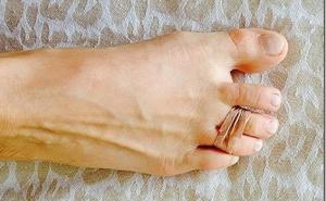  Znate li zašto je dobro vezati treći i četvrti nožni prst običnom gumicom?