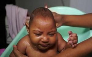 Virus Zika eksplozivno se širi: Prvi pacijent i u Austriji