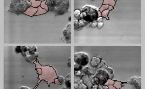 Naučnici zabilježili kako se zdrava ćelija pretvara u tumor (VIDEO)