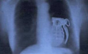 Najčudnije stvari snimljene na rendgenu: Makaze, granate, baterije, ekseri... (VIDEO)