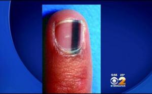 Ne zanemarujte promjene na noktima - spriječite smrtonosne bolesti 