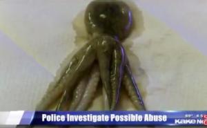 Dječaku doktori pronašli hobotnicu u grlu (VIDEO)