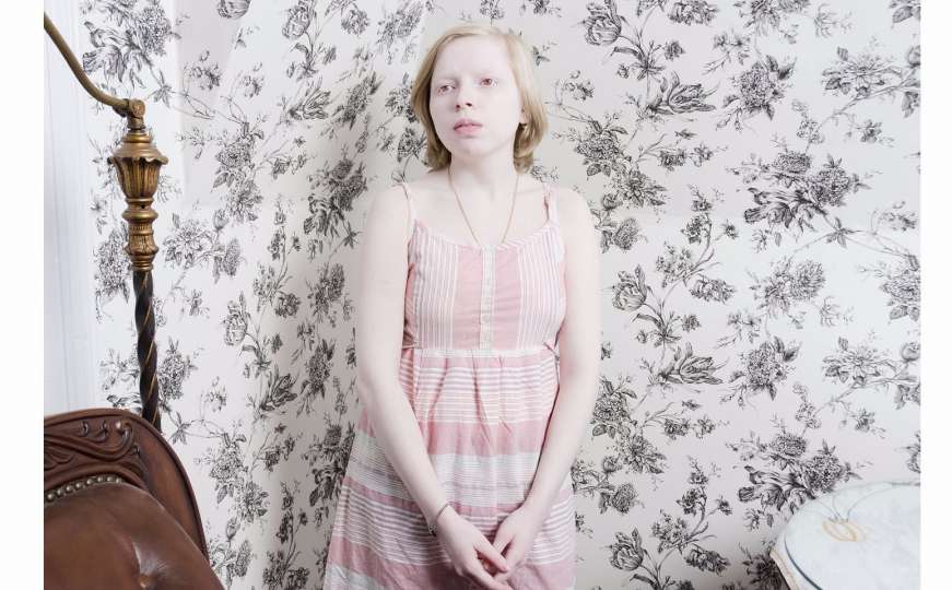 Zbog sujevjerja, albino osobama prijete potpunim istrebljenjem