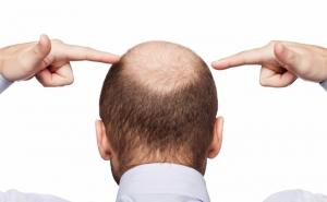 Zašto ljudi gube kosu?