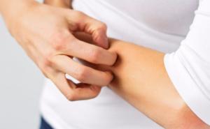 Kako da vas prestane svrbiti nakon što vas ujede komarac?