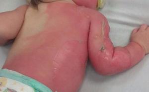 Majka nanijela opekotine drugog stepena devetomjesečnoj bebi