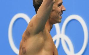 Evo zašto brojni Olimpijci imaju ove čudne modrice