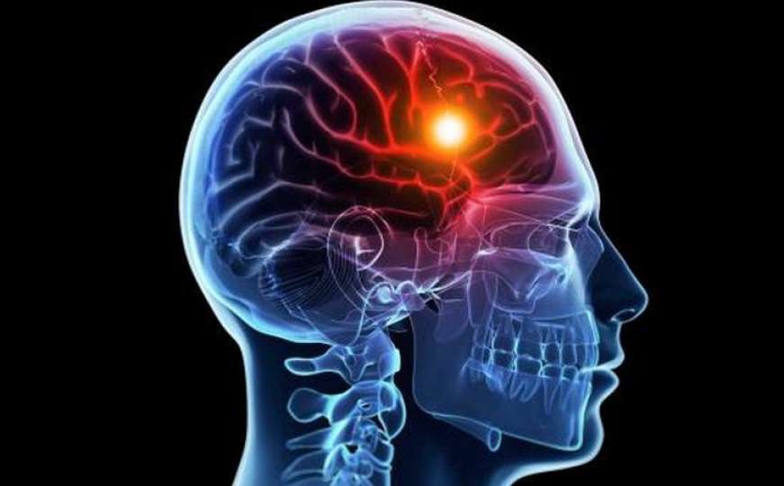 6 znakova upozorenja: Simptomi koji prethode moždanom udaru
