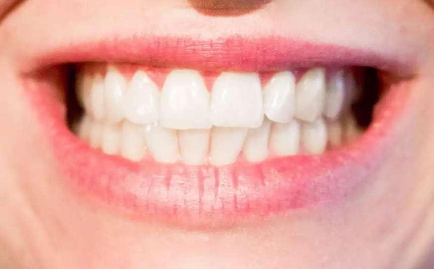 Kako izbijeliti zube kod kuće? 