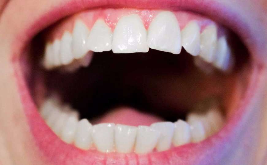 Kako izbijeliti zube u dva koraka