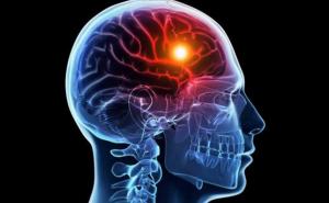 Moždani udar godišnje usmrti šest miliona ljudi 