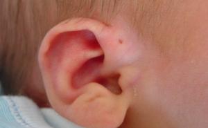 Znate li zašto neki ljudi imaju ovu rupicu pored uha