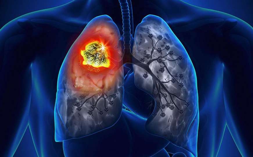 Važno je znati: Ovo su prvi simptomi raka pluća