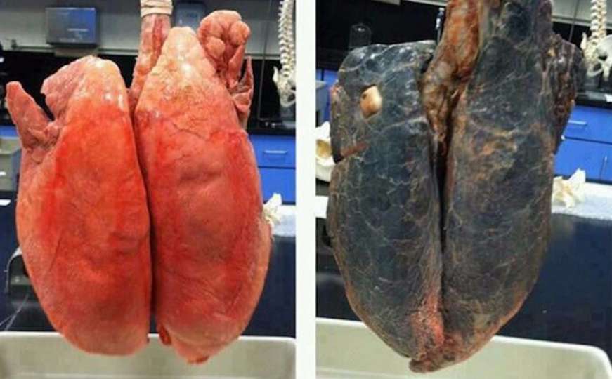 Pogledajte zastrašujuću razliku između normalnih i pluća pušača