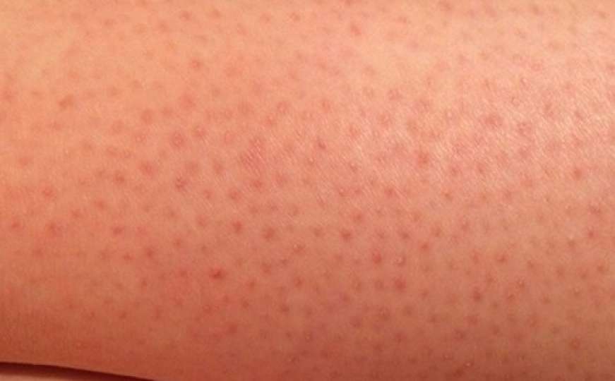 Užasno: Znate li zašto vam se poslije brijanja na nogama pojave crvene tačke?