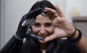 Inspirativna priča djevojke s bioničkom rukom: Čvršće se drži za život