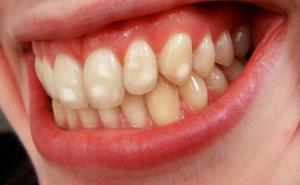 Znate li zašto neki ljudi imaju bijele mrlje na zubima