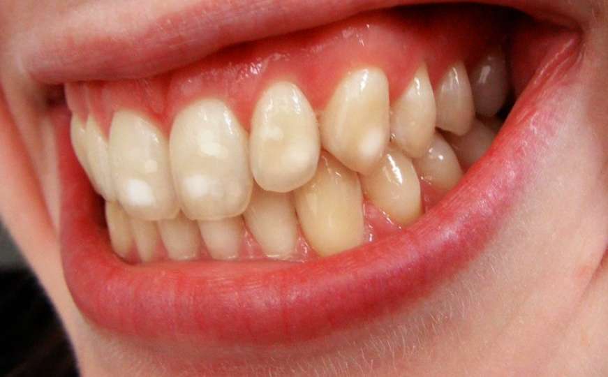 Znate li zašto neki ljudi imaju bijele mrlje na zubima