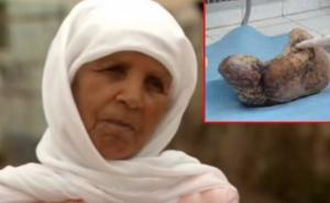 Žena bila trudna 46 godina: Doktori se šokirali šta su joj izvadili iz stomaka