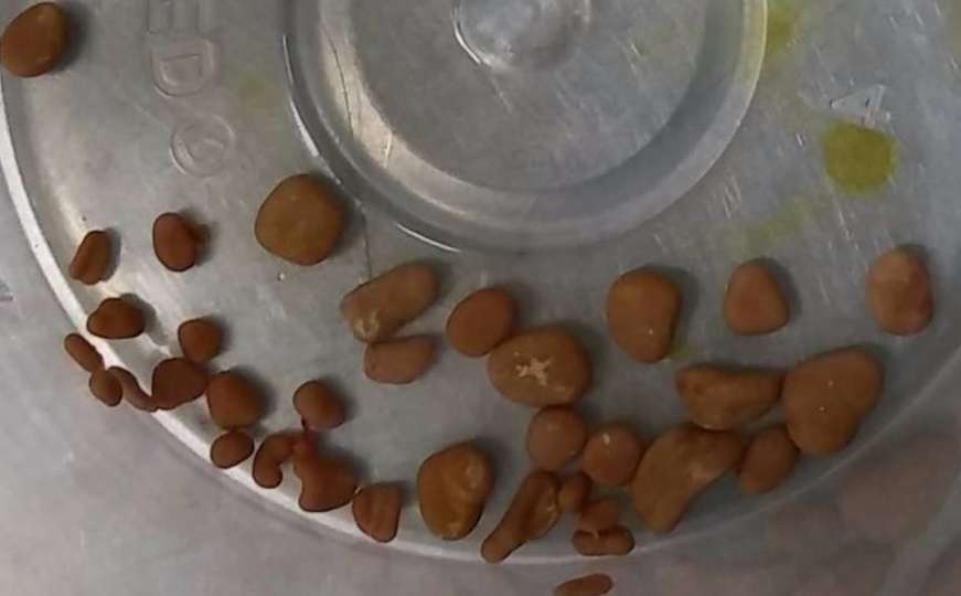 Petomjesečnoj bebi iz bubrega izvađeno 56 kamenčića