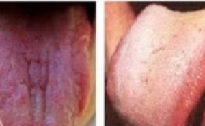 10 stvari koje vaš jezik govori o vašem zdravlju