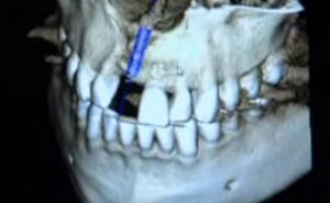 Zaboravite implantate! Uskoro će vam zubi izrasti za 9 sedmica 