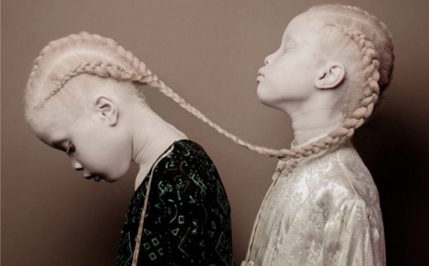 Predivne albino bliznakinje svojom jedinstvenošću osvojile svijet