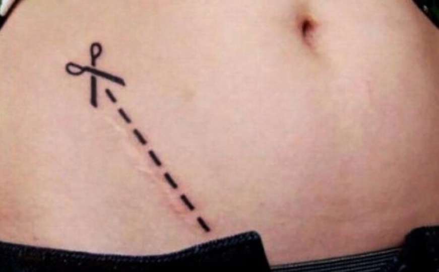 Tetovažama sakrili ožiljke koji ih podsjećaju na ružne događaje 