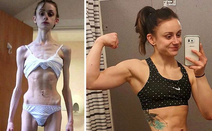 Hrabre žene i muškarci koji su pobijedili anoreksiju