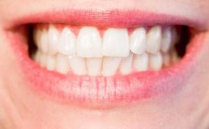 Četiri koraka do savršeno bijelih zuba bez kamenca