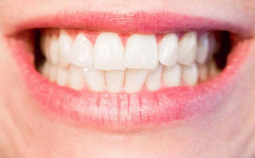 Četiri koraka do savršeno bijelih zuba bez kamenca