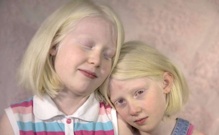Albino populacija: Najviše nas bole znatiželjni pogledi na ulici