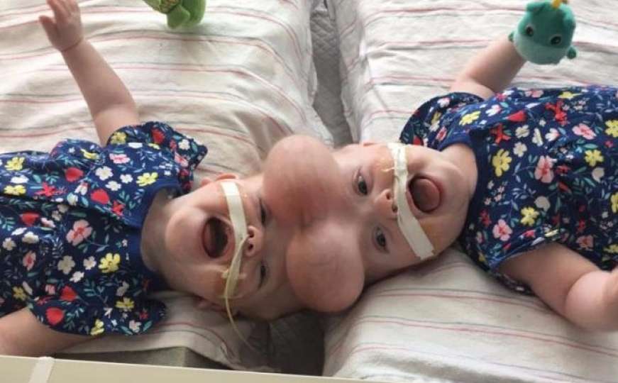 Sijamski blizanci razdvojeni nakon 11-satnog hirurškog zahvata