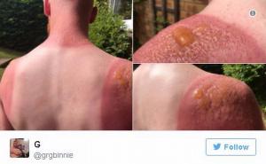 Vrtlar zadobio strašne opekotine: Ozbiljno, stavljajte zaštitnu kremu