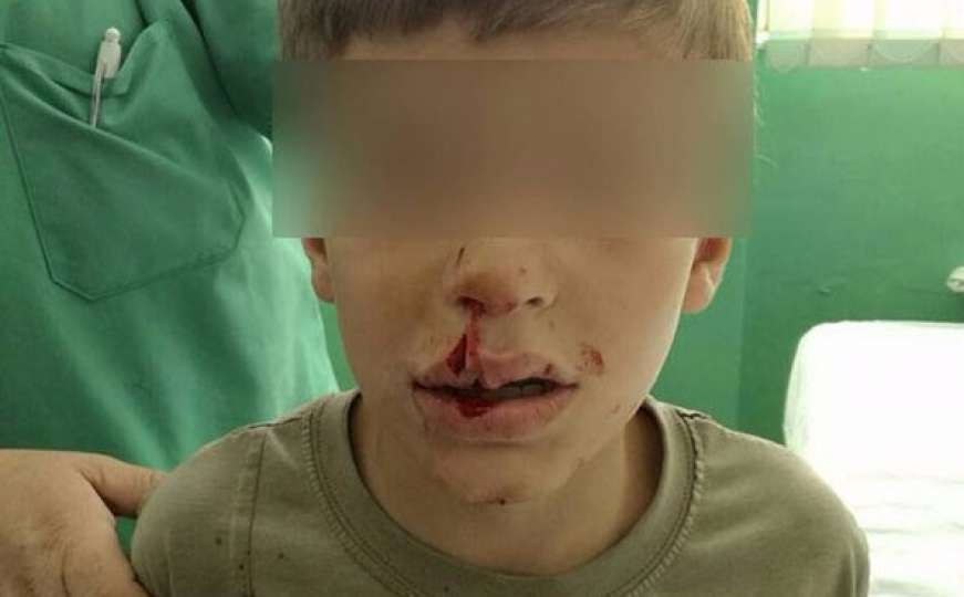 Pas lutalica sedmogodišnjaku nanio teške povrede lica
