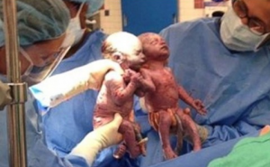 Bliznakinje došle na svijet držeći se za ruke