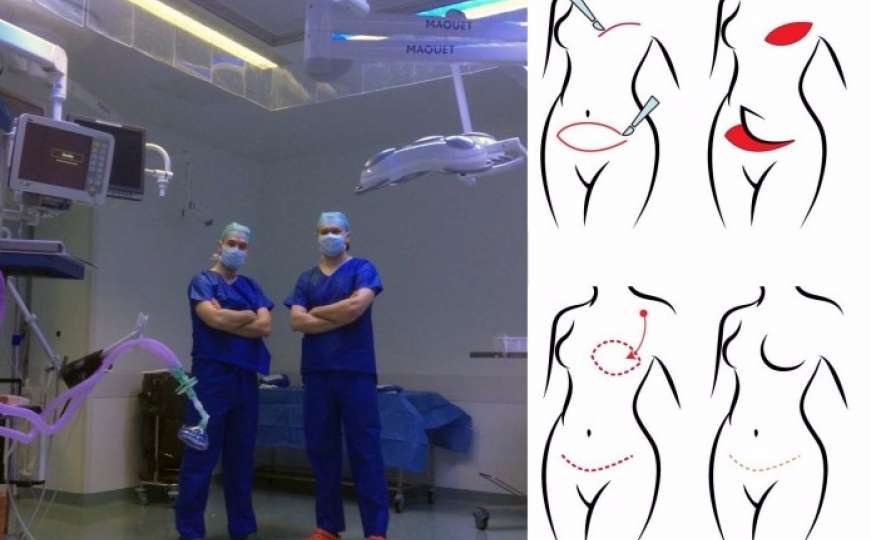 Na Klinici za plastičnu hirurgiju KCUS-a rekonstrukcija dojke vlastitim tkivom