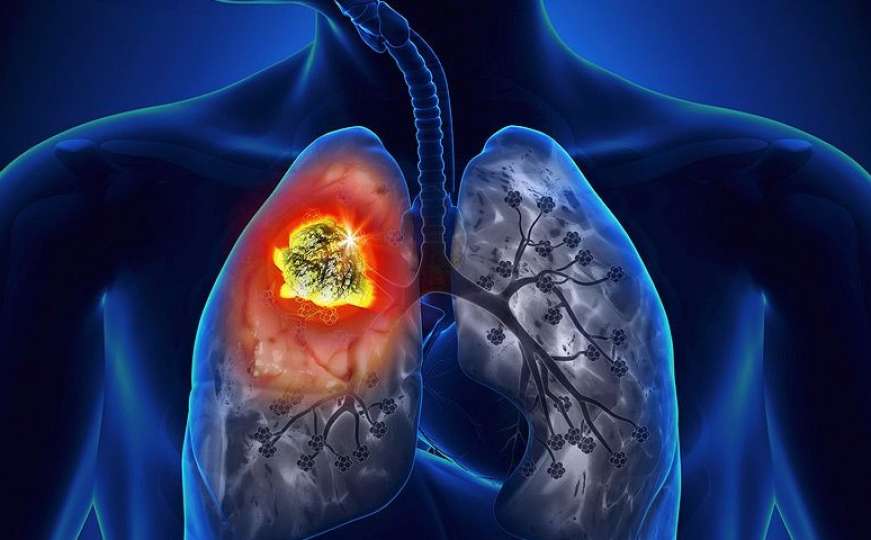 Testiranjem daha moći će se otkriti rak pluća u ranoj fazi