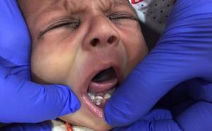 Prvi slučaj na svijetu: Beba rođena sa sedam izraslih zuba