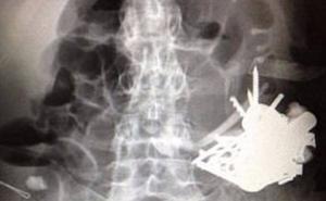 Doktori izvadili 100 komada: Muškarac godinama gutao igle i novčiće