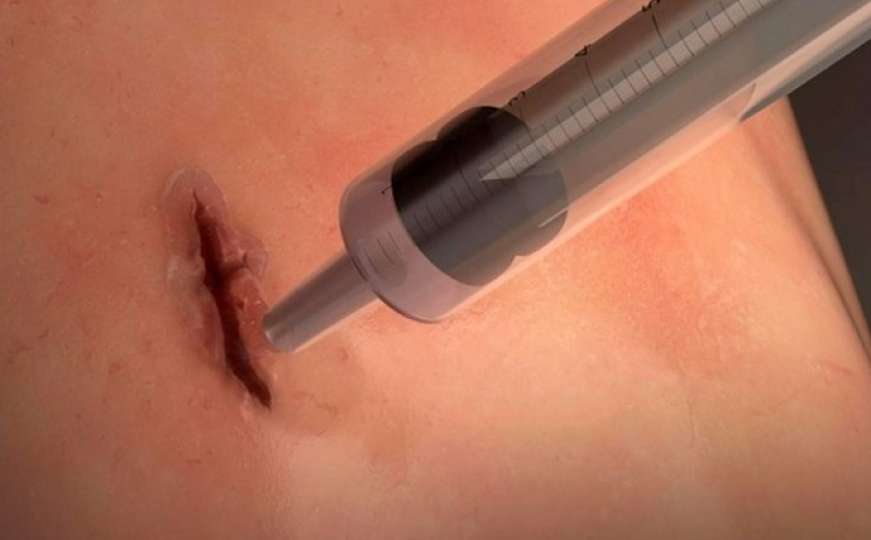 Zaboravite šivanje: Izumljeno hirurško ljepilo koje zatvara rane za 60 sekundi