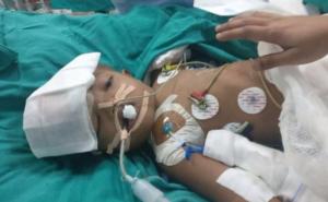 Indija: Ljekari razdvojili sijamske blizance spojene glavama