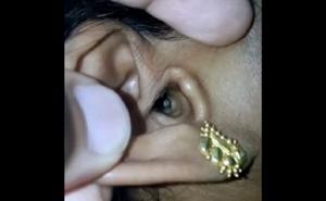 Imala je jake glavobolje, a doktor joj je pronašao pauka u uhu